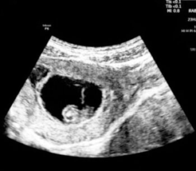 Ultrasound photo